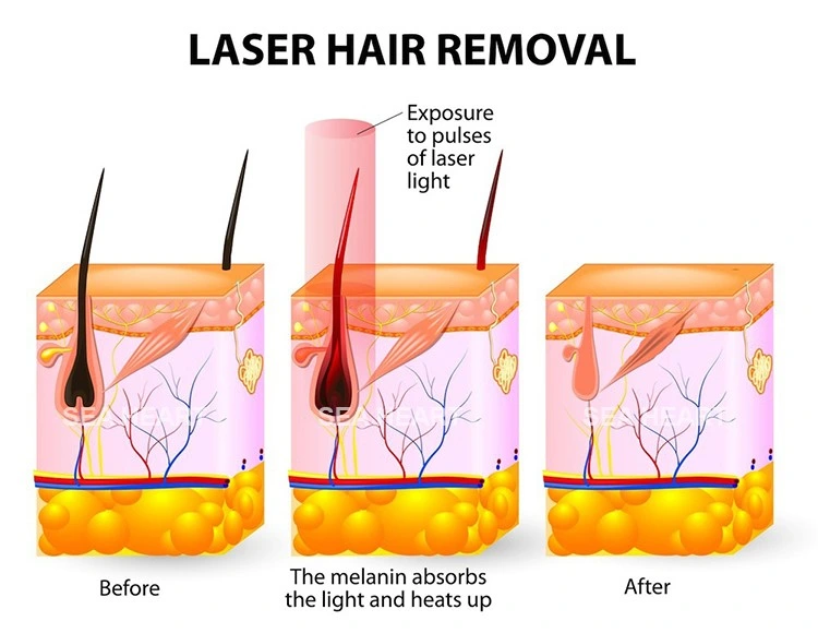 1064nm Long Pulsed ND YAG Laser for Hair Removal